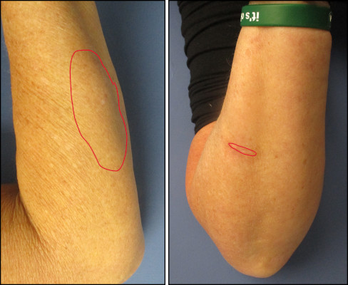 Chicago mole removal shave no scarring